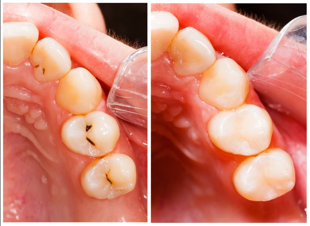 White-coloured composite Fillings, white fillings, esthetic dentistry