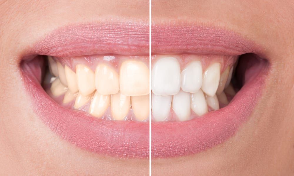 Teeth Whitening, whiter teeth, brighter smile