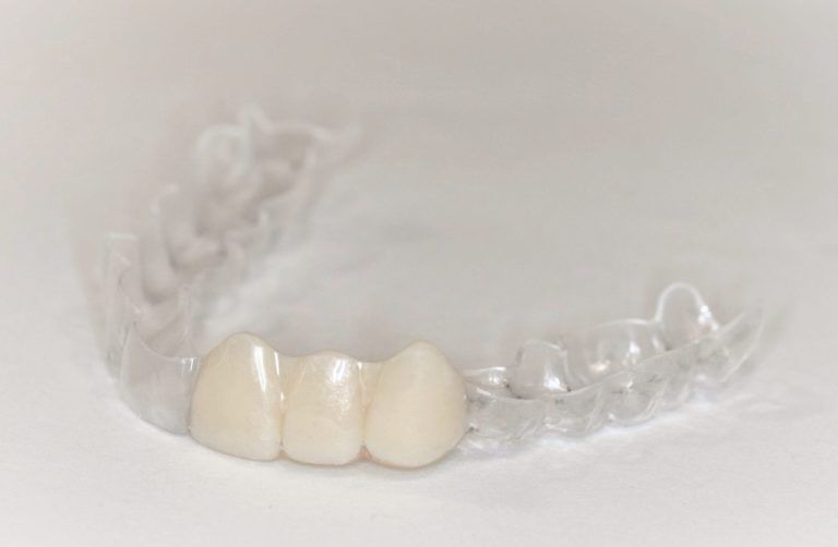 Essix Retainers Dentists in Surrey Vivant Dental