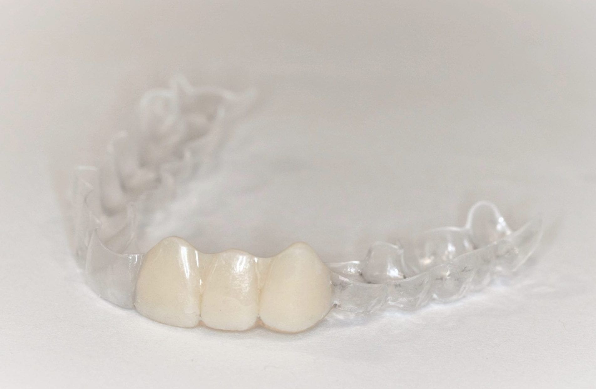 Essix retainer for missing teeth